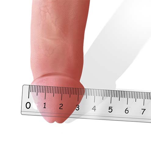 measure flaccid glans width foreskin restoration
