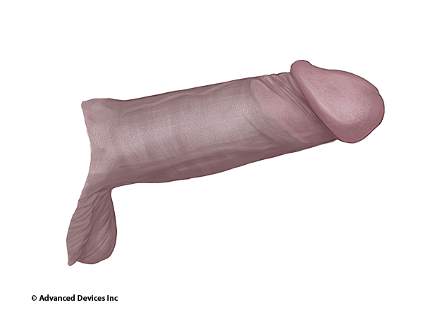 foreskin restoration coverage penis