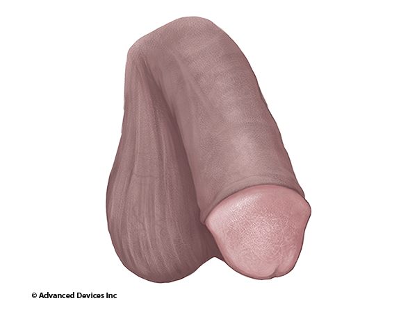 foreskin restoration coverage index penis