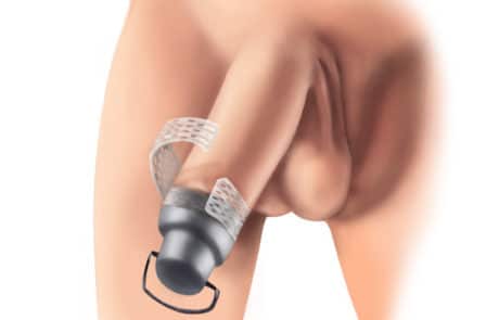 foreskin restoration canister device tape