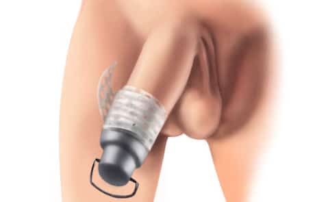 foreskin restoration canister device